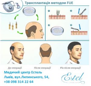 Трансплантація волосся методом FUE